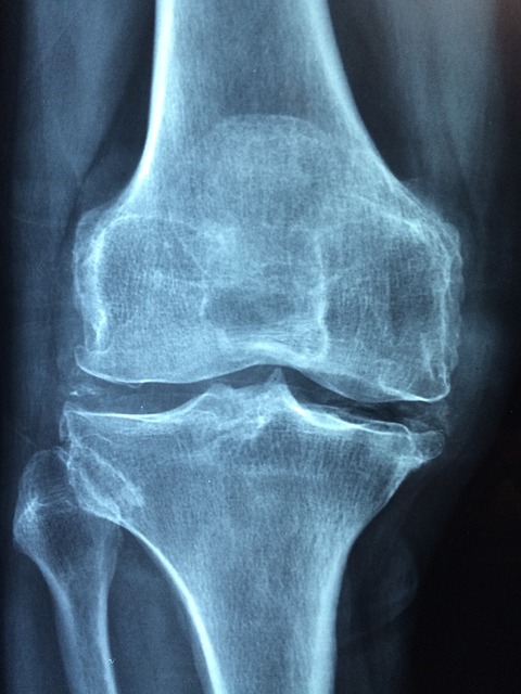 Radiographie de l'articulation du genou, peut-être atteint d'arthrose.